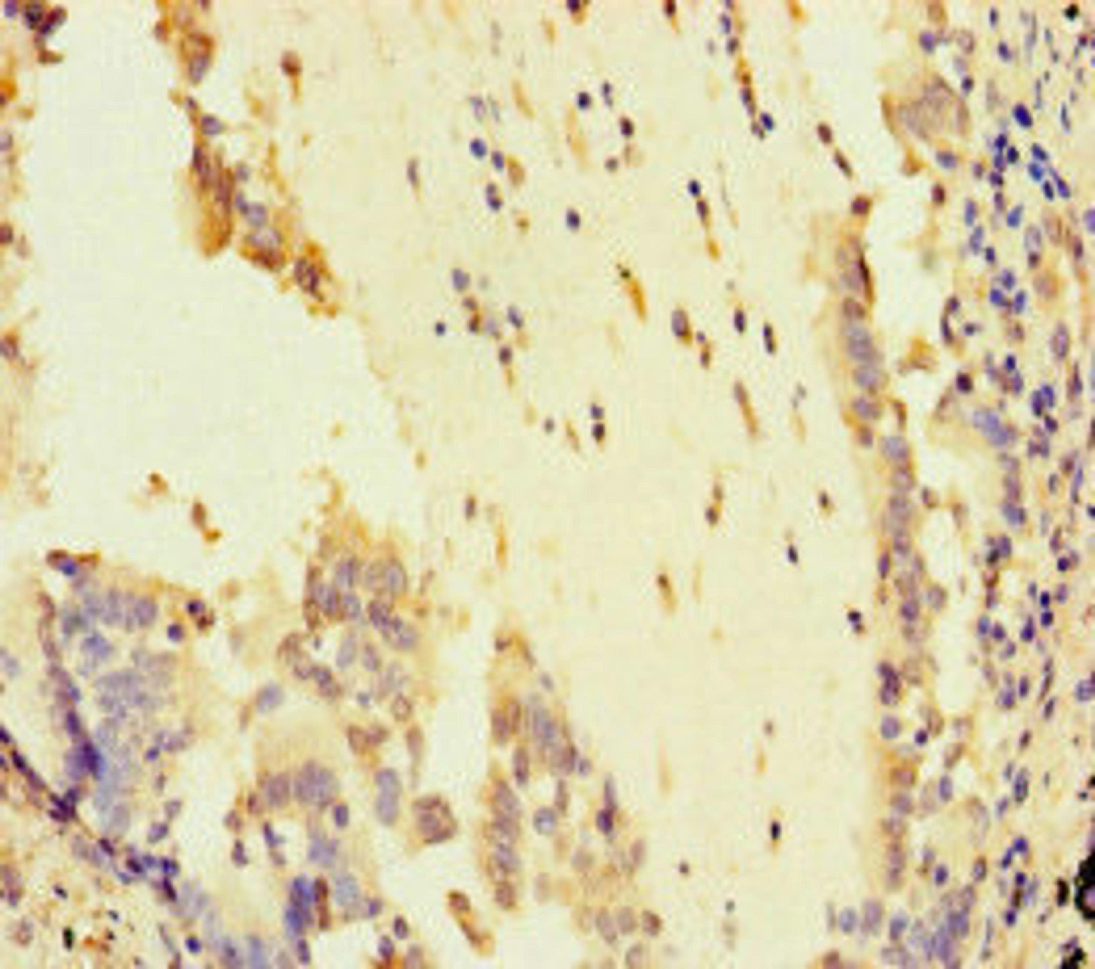 Immunohistochemistry of paraffin-embedded human lung cancer using CSB-PA622666LA01HU at dilution of 1:100