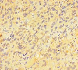 Immunohistochemistry of paraffin-embedded human glioma using CSB-PA885746LA01HU at dilution of 1:100