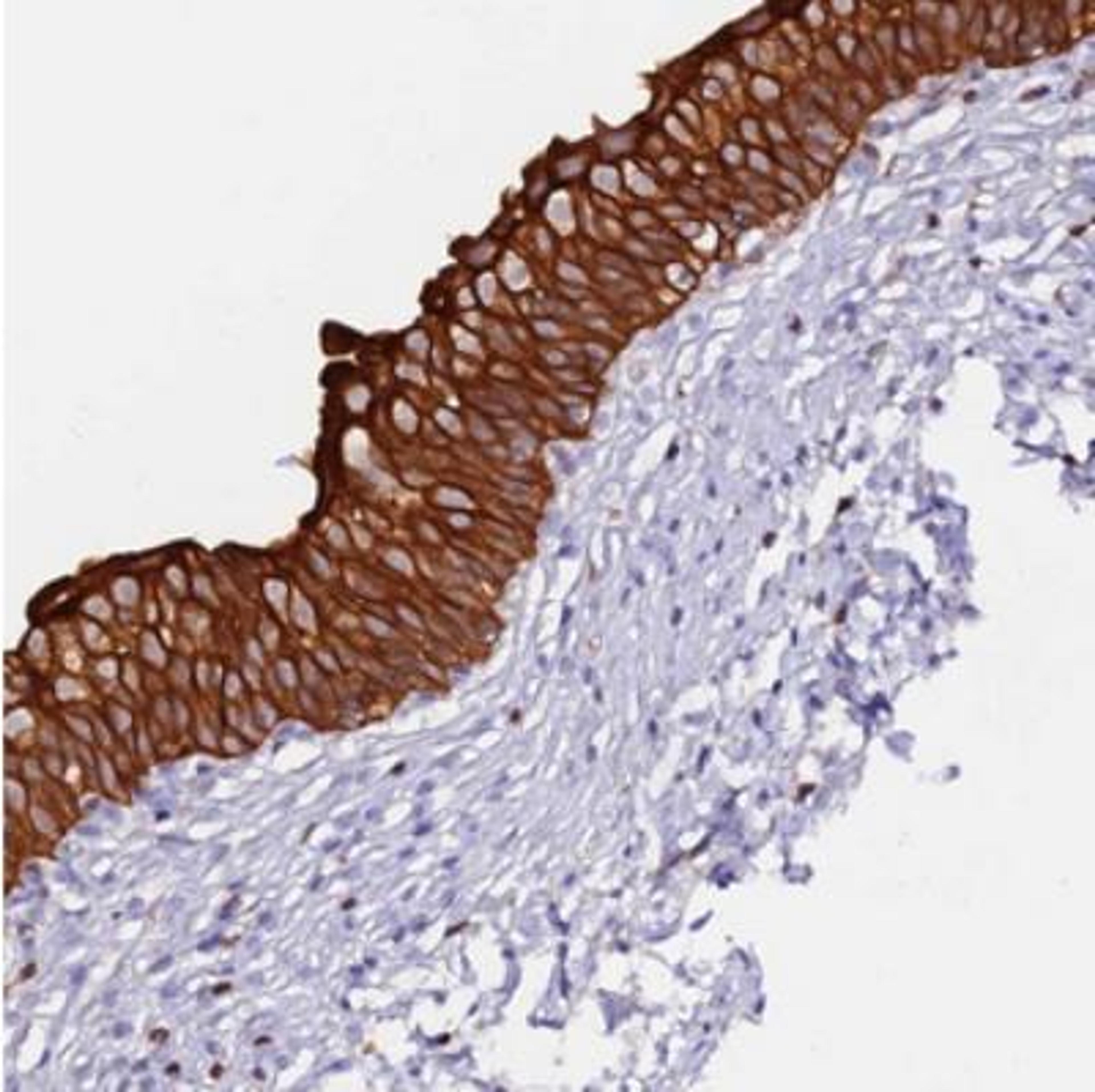 Immunohistochemistry: DENN/MADD Domain Containing 2D Antibody [NBP2-30995] - Immunohistochemical staining of human urinary bladder shows strong cytoplasmic and membranous positivity in urothelium.