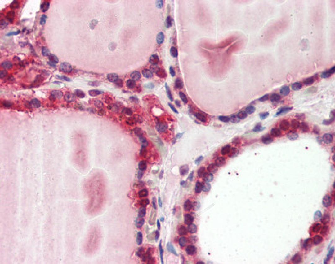 Immunohistochemistry staining of Cathepsin K in thyroid tissue using Cathepsin K Antibody.