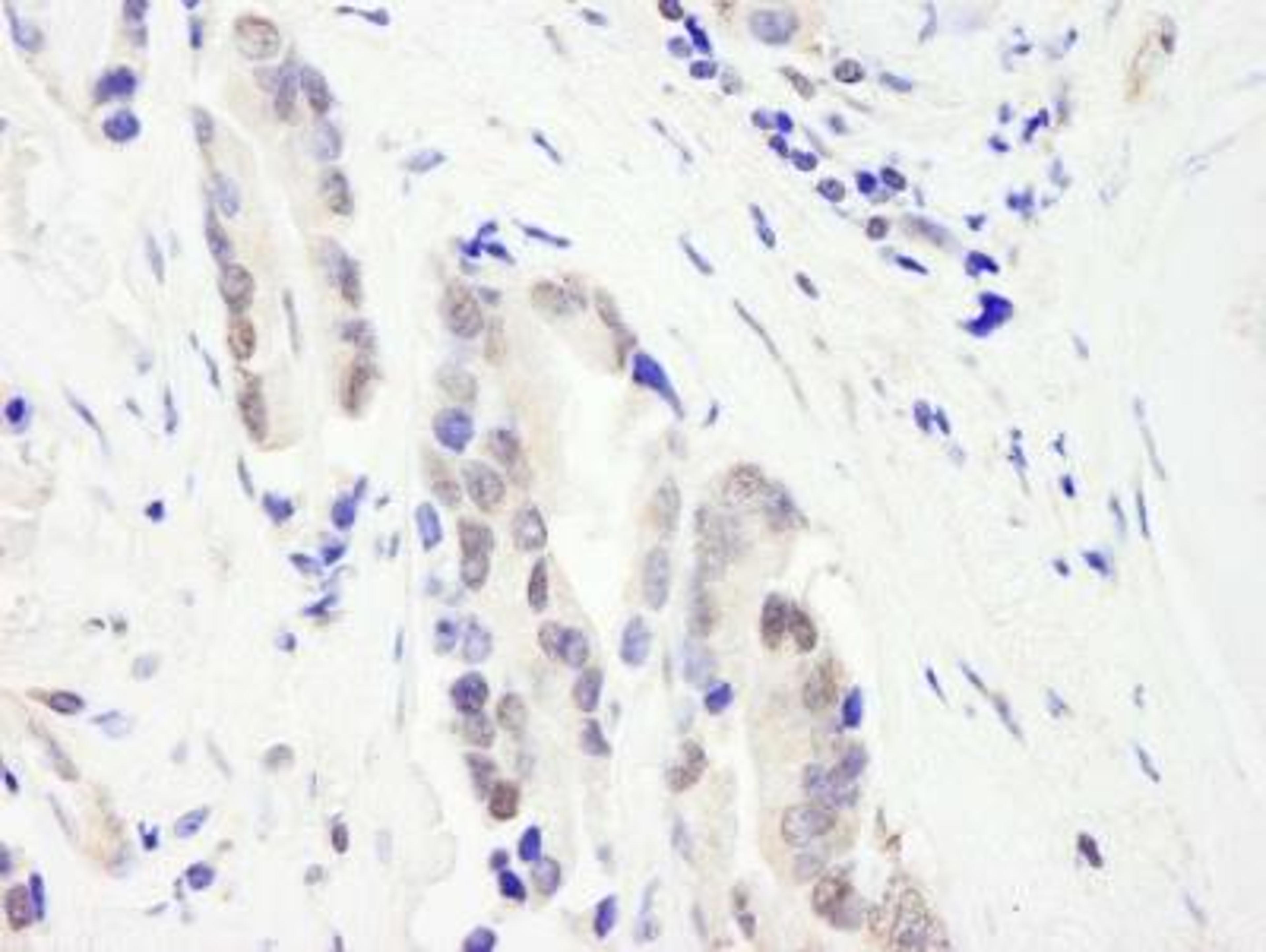 Immunohistochemistry-Paraffin: CHD3 Antibody [NB100-60412] - Human prostate carcinoma. Antibody used at a dilution of 1:1000 (1ug/ml).