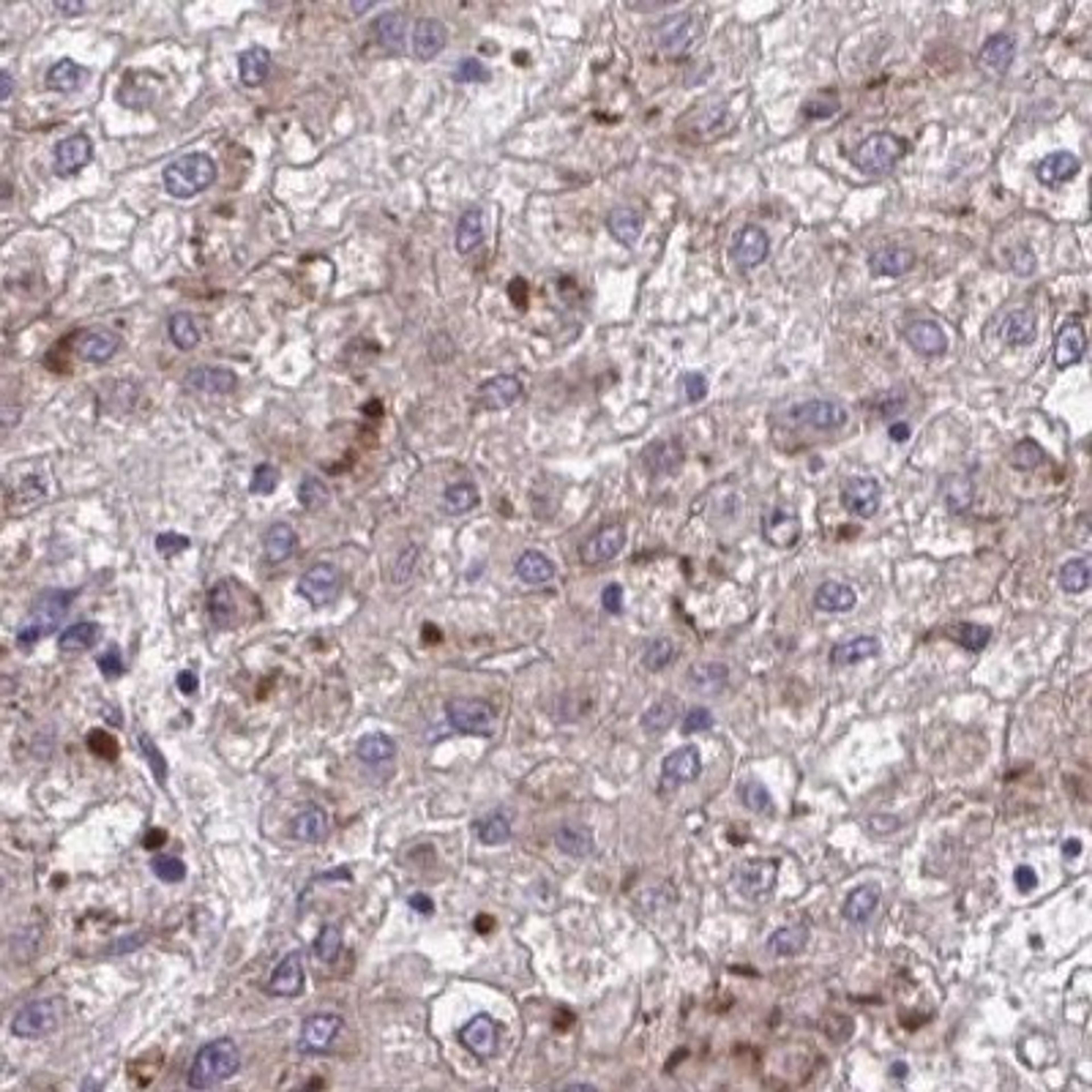 Immunohistochemistry: SUSD4 Antibody [NBP2-31711] - liver cancer