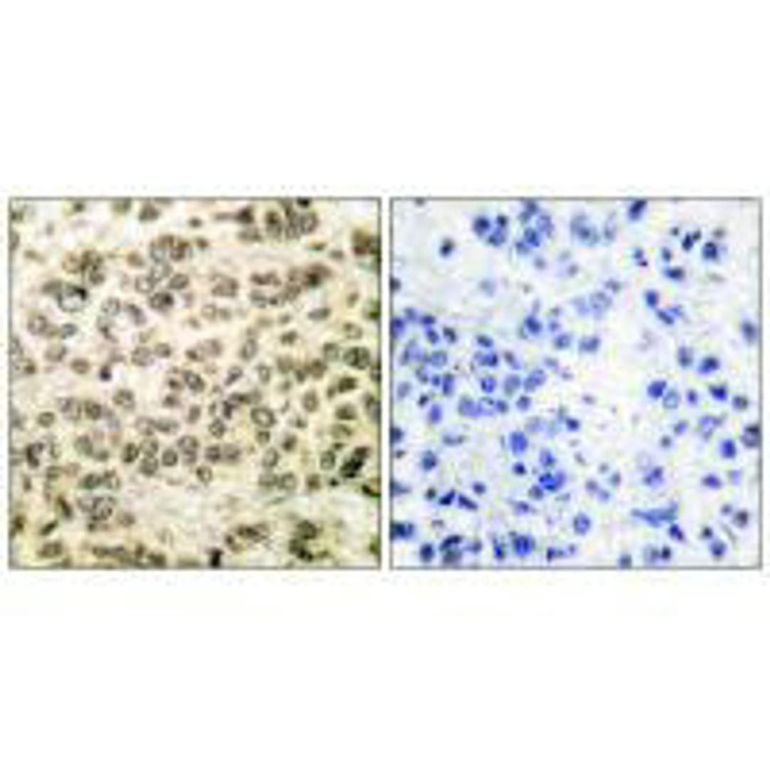 Immunohistochemical analysis of paraffin-embedded human breast carcinoma tissue using HDAC3 antibody.