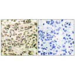 Immunohistochemical analysis of paraffin-embedded human breast carcinoma tissue using HDAC3 antibody.
