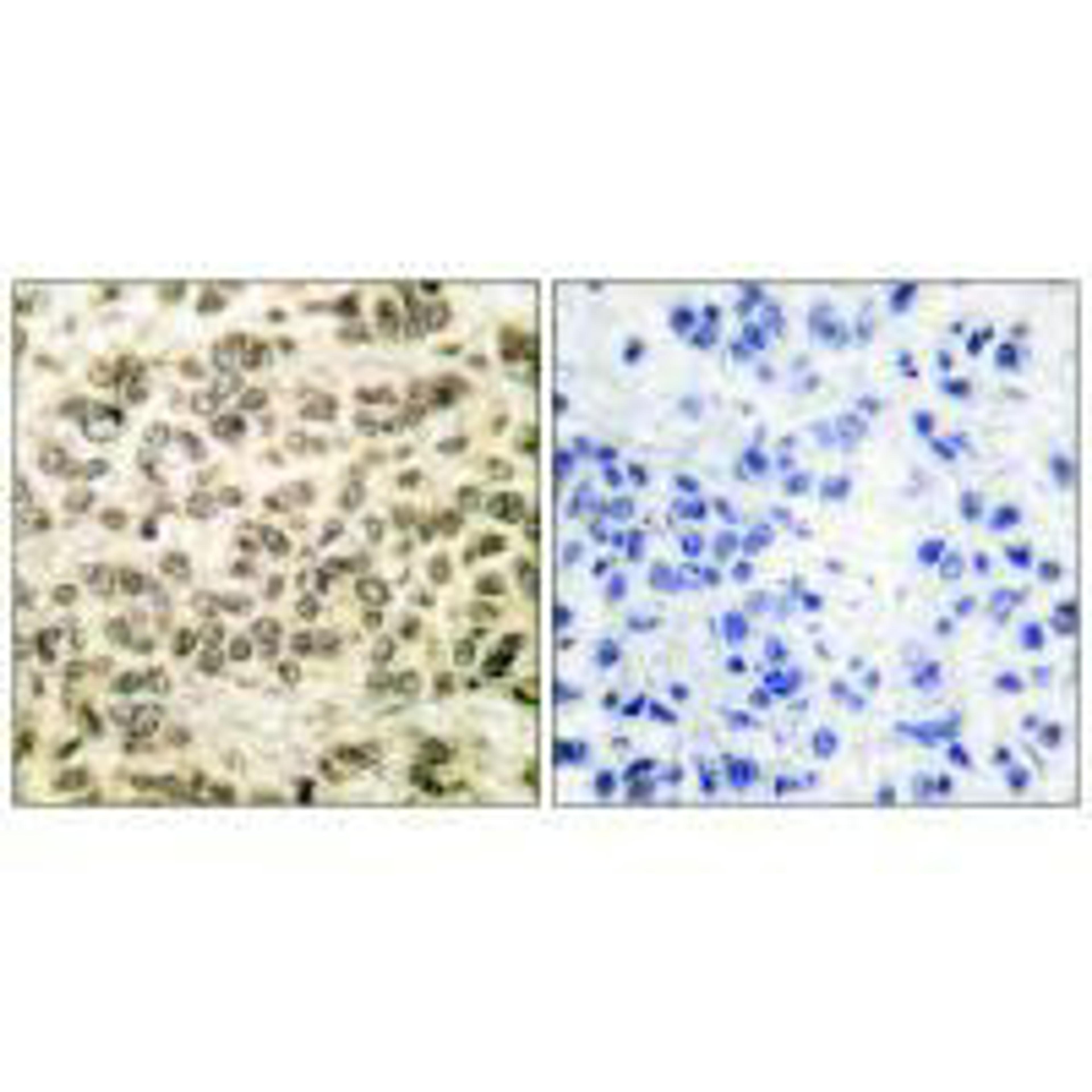Immunohistochemical analysis of paraffin-embedded human breast carcinoma tissue using HDAC3 antibody.