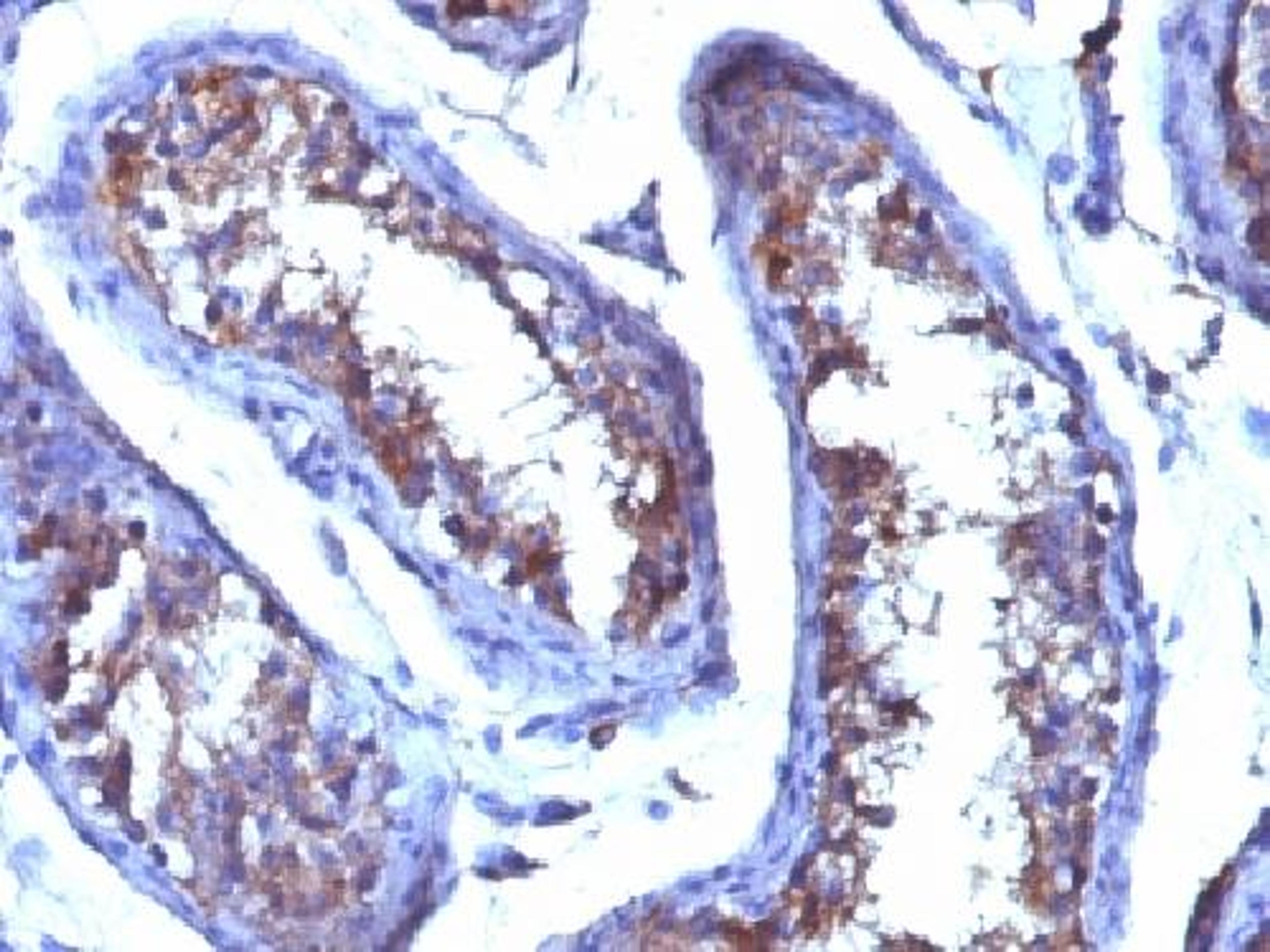 Immunohistochemical staining of human Testicular Carcinoma tissue using C19H28O2 antibody