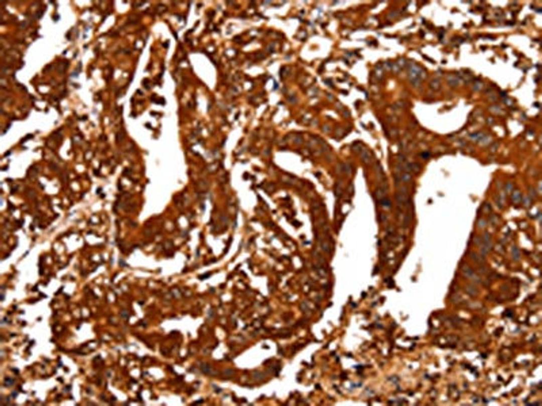 The image on the left is immunohistochemistry of paraffin-embedded Human gastic cancer tissue using CSB-PA909976(ALDOA Antibody) at dilution 1/25, on the right is treated with fusion protein. (Original magnification: ×200)