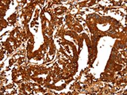 The image on the left is immunohistochemistry of paraffin-embedded Human gastic cancer tissue using CSB-PA909976(ALDOA Antibody) at dilution 1/25, on the right is treated with fusion protein. (Original magnification: ×200)