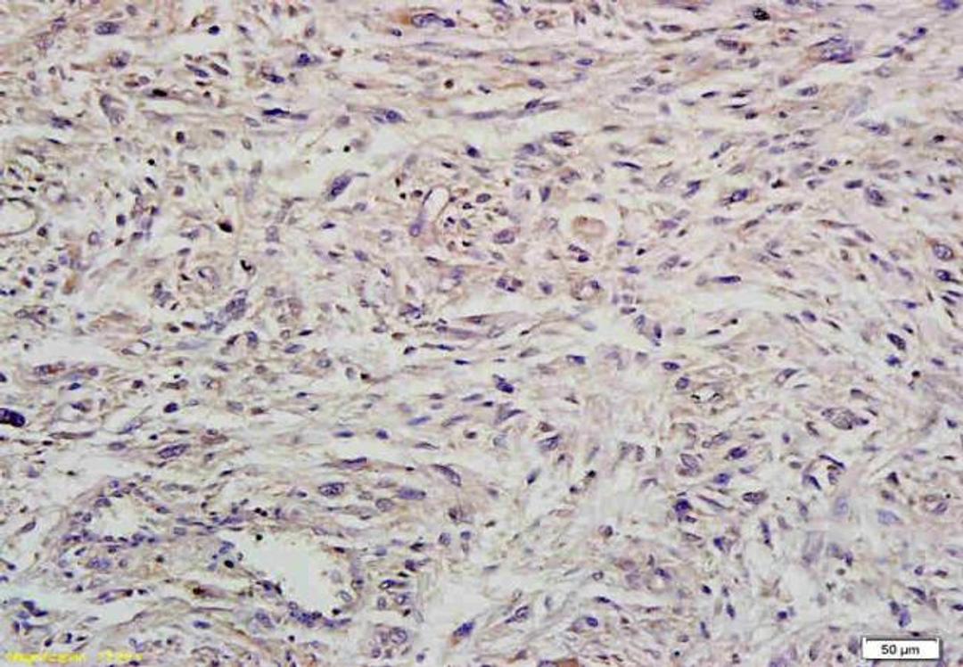 Immunohistochemical analysis of paraffin-embedded human brain glioma tissue using MIIP antibody.