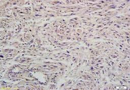 Immunohistochemical analysis of paraffin-embedded human brain glioma tissue using MIIP antibody.