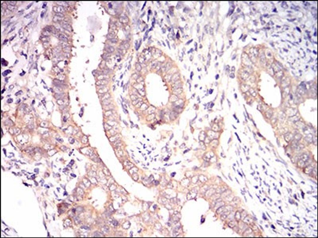 Immunohistochemistry: eIF2A Antibody (3A7A8) [NBP2-37279] - Immunohistochemical analysis of paraffin-embedded cervical cancer tissues using EIF2A mouse mAb with DAB staining.