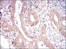 Immunohistochemistry: eIF2A Antibody (3A7A8) [NBP2-37279] - Immunohistochemical analysis of paraffin-embedded cervical cancer tissues using EIF2A mouse mAb with DAB staining.