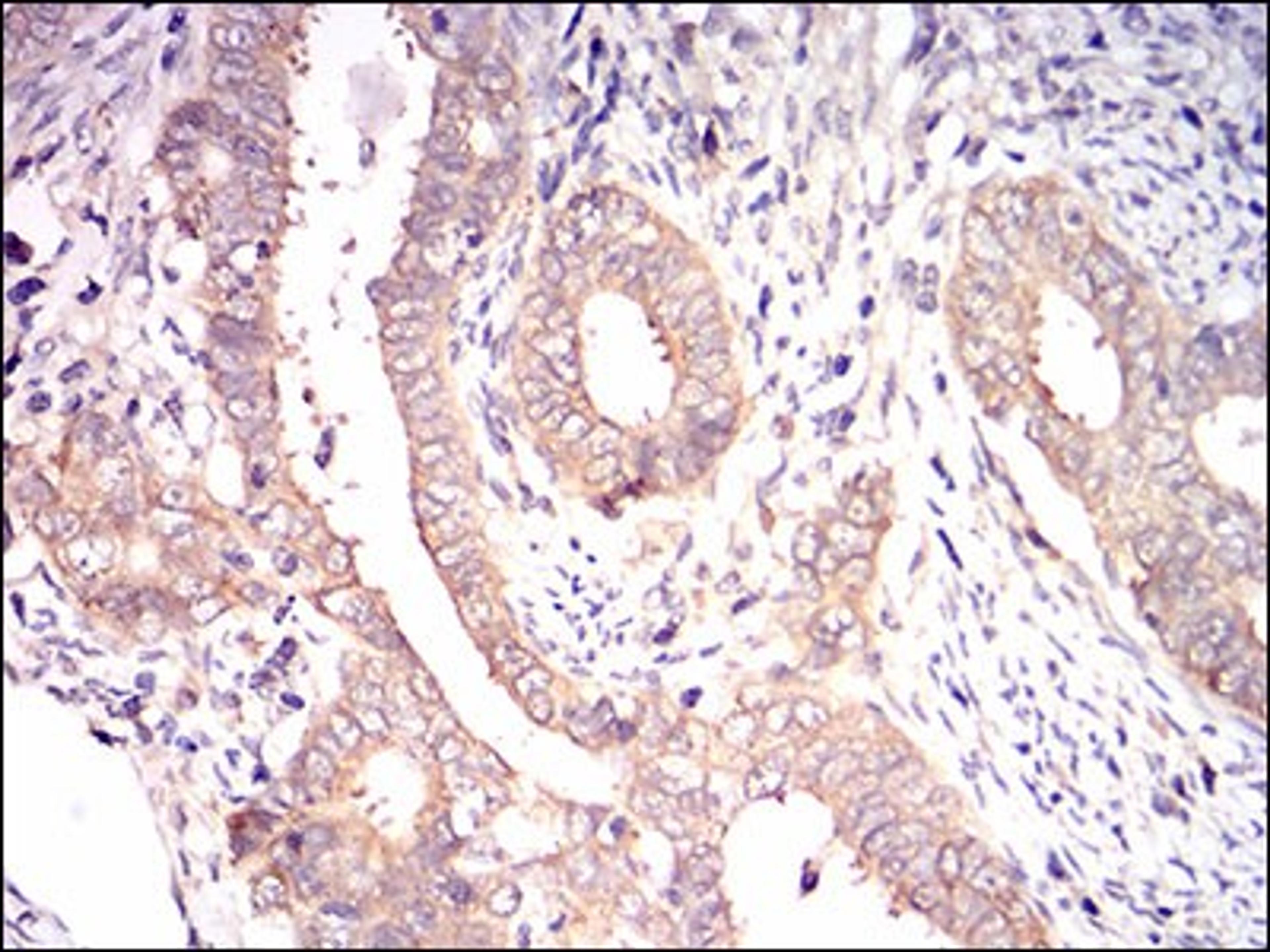 Immunohistochemistry: eIF2A Antibody (3A7A8) [NBP2-37279] - Immunohistochemical analysis of paraffin-embedded cervical cancer tissues using EIF2A mouse mAb with DAB staining.