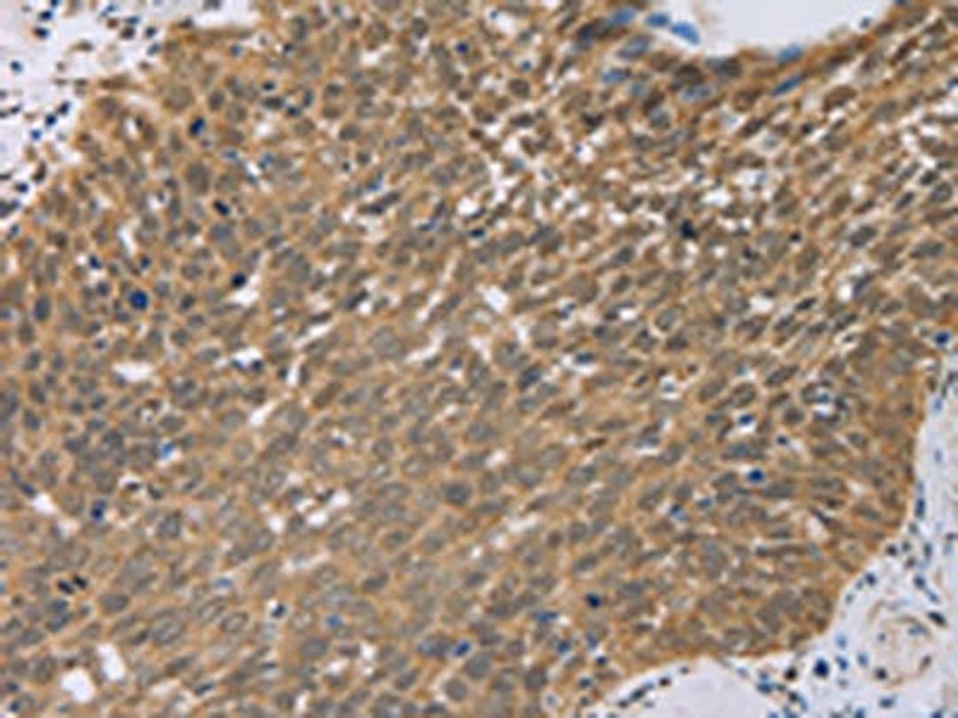 The image on the left is immunohistochemistry of paraffin-embedded Human cervical cancer tissue using CSB-PA166329(PCP4 Antibody) at dilution 1/50, on the right is treated with fusion protein. (Original magnification: ×200)