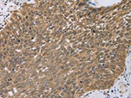 The image on the left is immunohistochemistry of paraffin-embedded Human cervical cancer tissue using CSB-PA166329(PCP4 Antibody) at dilution 1/50, on the right is treated with fusion protein. (Original magnification: ×200)
