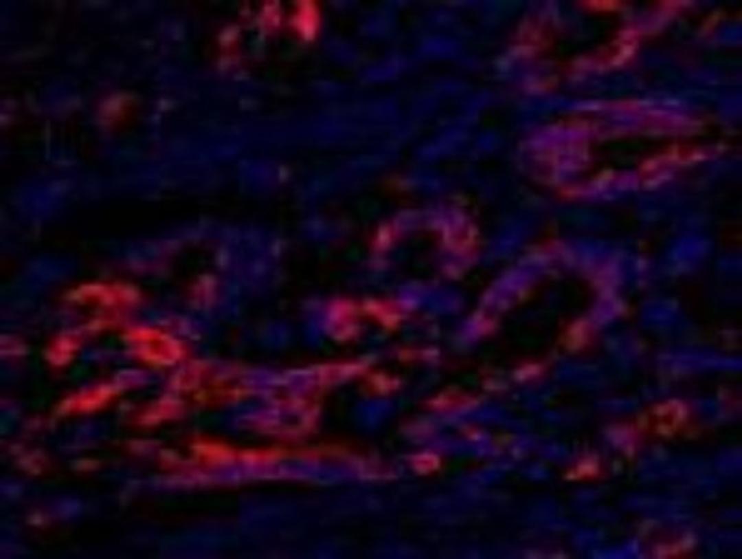 Immunocytochemistry/Immunofluorescence: EEF2K Antibody [NB100-87019] - FFPE section of human colon carcinoma.  Affinity purified rabbit anti-eEF2 Kinase used at a dilution of 1:100.