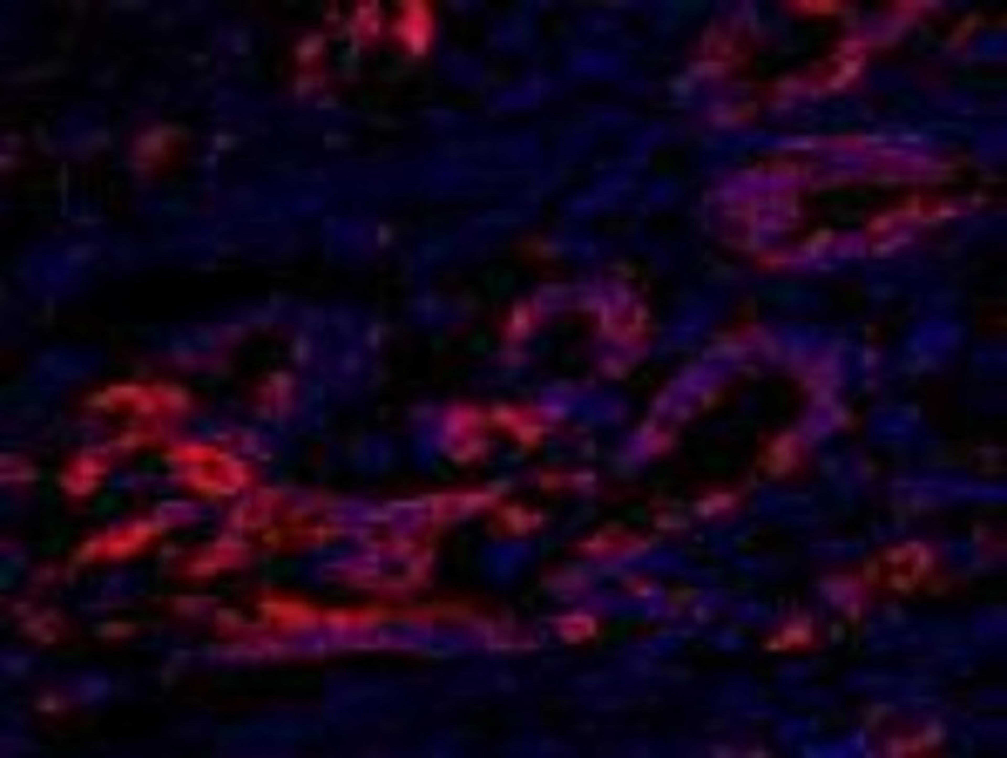 Immunocytochemistry/Immunofluorescence: EEF2K Antibody [NB100-87019] - FFPE section of human colon carcinoma.  Affinity purified rabbit anti-eEF2 Kinase used at a dilution of 1:100.