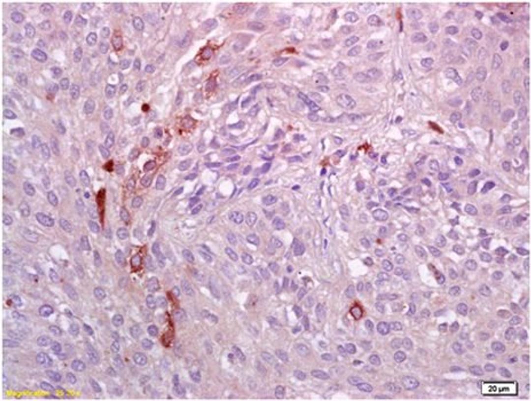 Immunohistochemical analysis of paraffin embedded and formalin fixed human lung carcinoma tissue using AXL (phospho-Tyr698/Tyr702/Tyr703) antibody