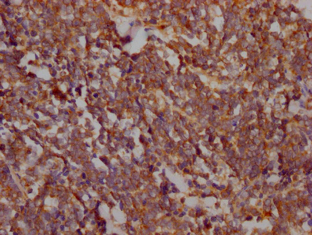 IHC image of CSB-RA198162A0HU diluted at 1:100 and staining in paraffin-embedded human lung cancer performed on a Leica BondTM system. After dewaxing and hydration, antigen retrieval was mediated by high pressure in a citrate buffer (pH 6.0). Section was blocked with 10% normal goat serum 30min at RT. Then primary antibody (1% BSA) was incubated at 4℃ overnight. The primary is detected by a Goat anti-rabbit IgG polymer labeled by HRP and visualized using 0.05% DAB.