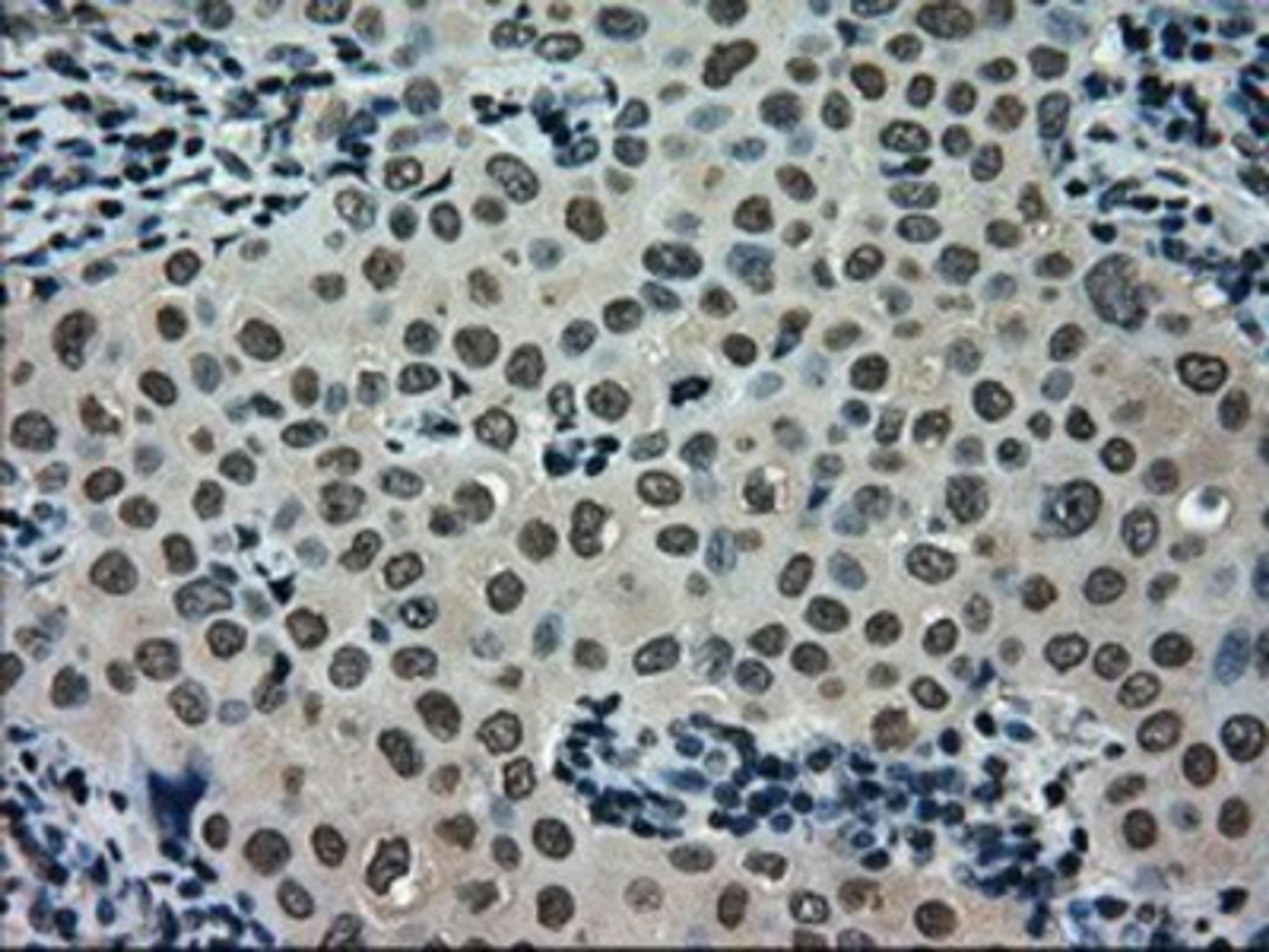 Immunohistochemistry-Paraffin: SCY1 like 3 Antibody (1A5) [NBP1-47956] - Staining of paraffin-embedded Adenocarcinoma of breast tissue using anti-SCY1 like 3 mouse monoclonal antibody.