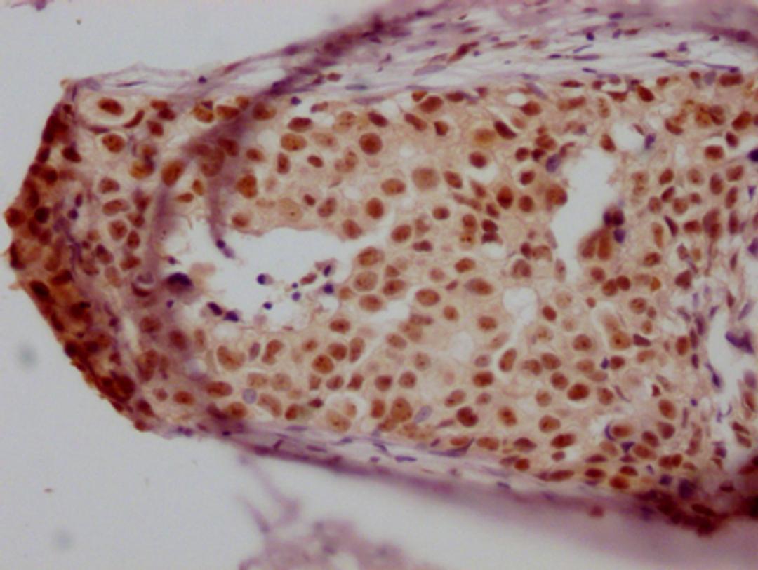 IHC image of CSB-RA988421A0HU diluted at 1:100 and staining in paraffin-embedded human breast cancer performed on a Leica BondTM system. After dewaxing and hydration, antigen retrieval was mediated by high pressure in a citrate buffer (pH 6.0). Section was blocked with 10% normal goat serum 30min at RT. Then primary antibody (1% BSA) was incubated at 4℃ overnight. The primary is detected by a Goat anti-rabbit IgG polymer labeled by HRP and visualized using 0.05% DAB.
