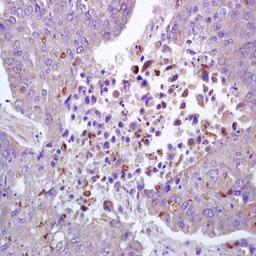 Immunohistochemical analysis of formalin-fixed and paraffin embedded human lung carcinoma tissue (Dilution at:1:200) using ROCK1 (phospho-Thr455/Ser456) antibody