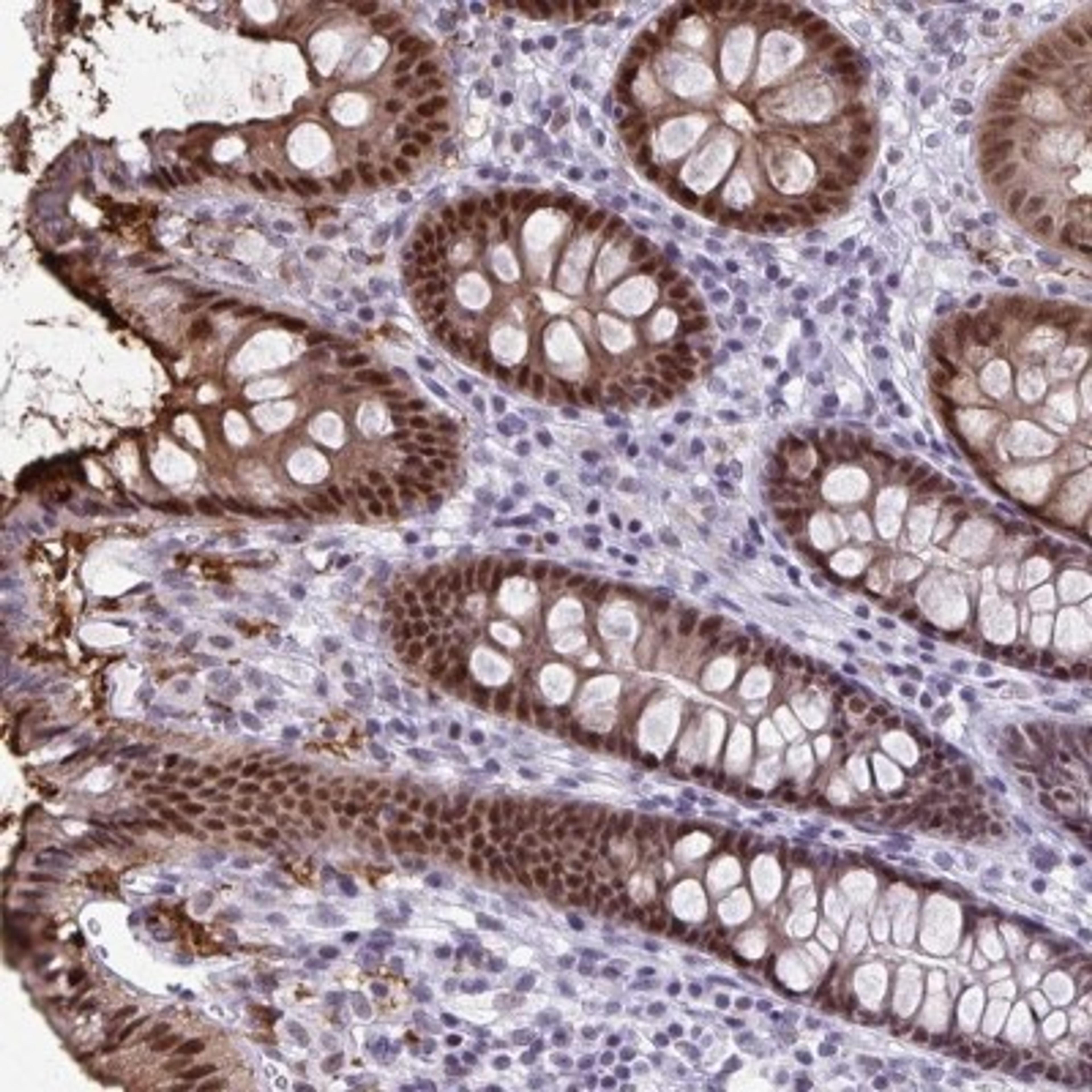 Immunohistochemistry: SS18 Antibody [NBP2-31612] - Staining of human colon shows strong nuclear, cytoplasmic and membranous positivity in glandular cells.