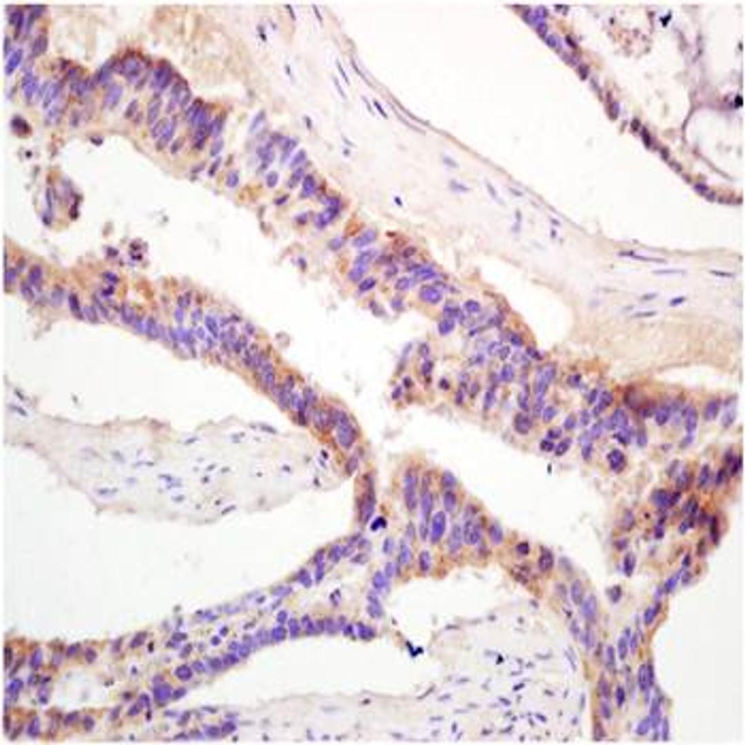 Paraffin-embedded human colon carcinoma fixed with 4% paraformaldehyde. Antigen retrieval by boiling with citrate buffer. Blocking buffer is goat serum (37 degrees for 20 min.). Glucose 6 phosphatase alpha antibody at 1:200 dilution with overnight incubat