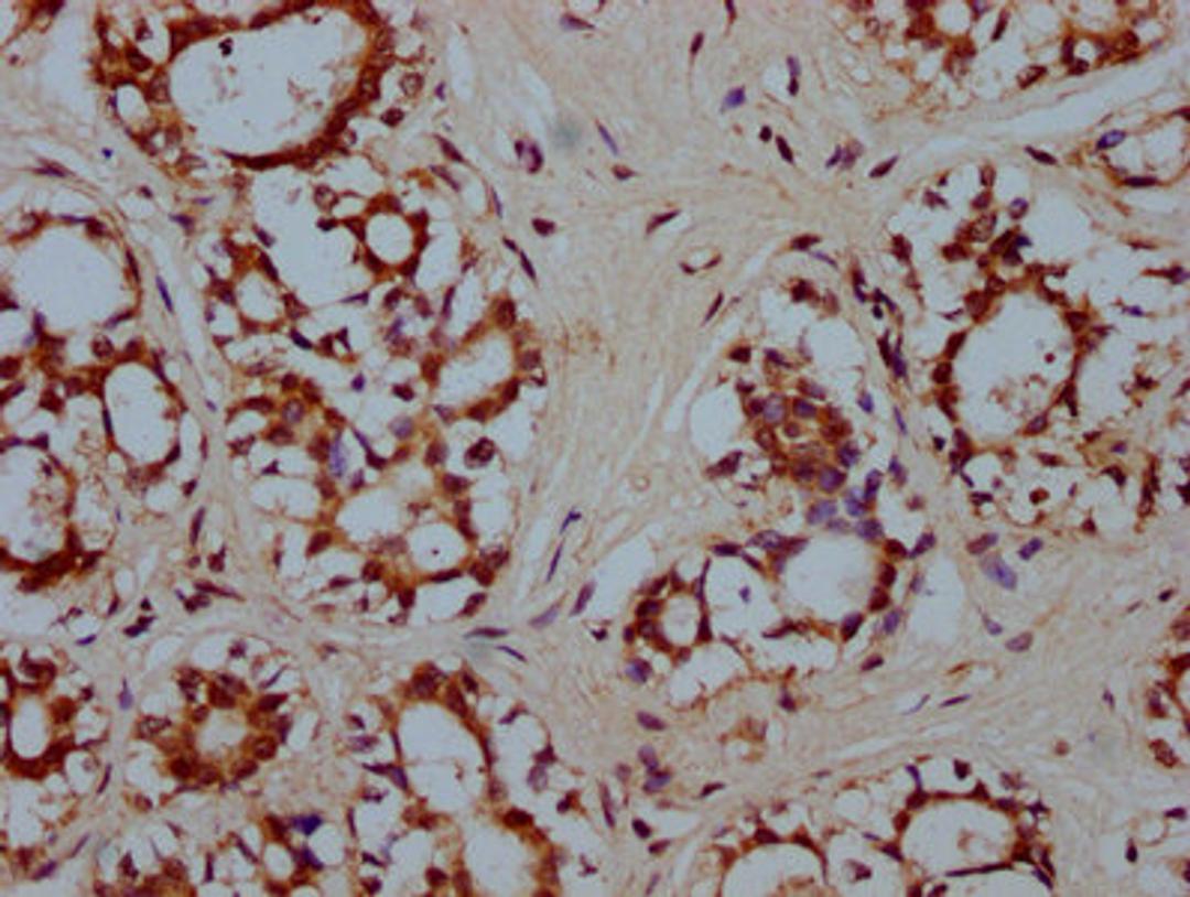 IHC image of CSB-PA010587LA01HU diluted at 1:300 and staining in paraffin-embedded human breast cancer performed on a Leica BondTM system. After dewaxing and hydration, antigen retrieval was mediated by high pressure in a citrate buffer (pH 6.0). Section was blocked with 10% normal goat serum 30min at RT. Then primary antibody (1% BSA) was incubated at 4&deg;C overnight. The primary is detected by a biotinylated secondary antibody and visualized using an HRP conjugated SP system.