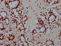 IHC image of CSB-PA010587LA01HU diluted at 1:300 and staining in paraffin-embedded human breast cancer performed on a Leica BondTM system. After dewaxing and hydration, antigen retrieval was mediated by high pressure in a citrate buffer (pH 6.0). Section was blocked with 10% normal goat serum 30min at RT. Then primary antibody (1% BSA) was incubated at 4&deg;C overnight. The primary is detected by a biotinylated secondary antibody and visualized using an HRP conjugated SP system.