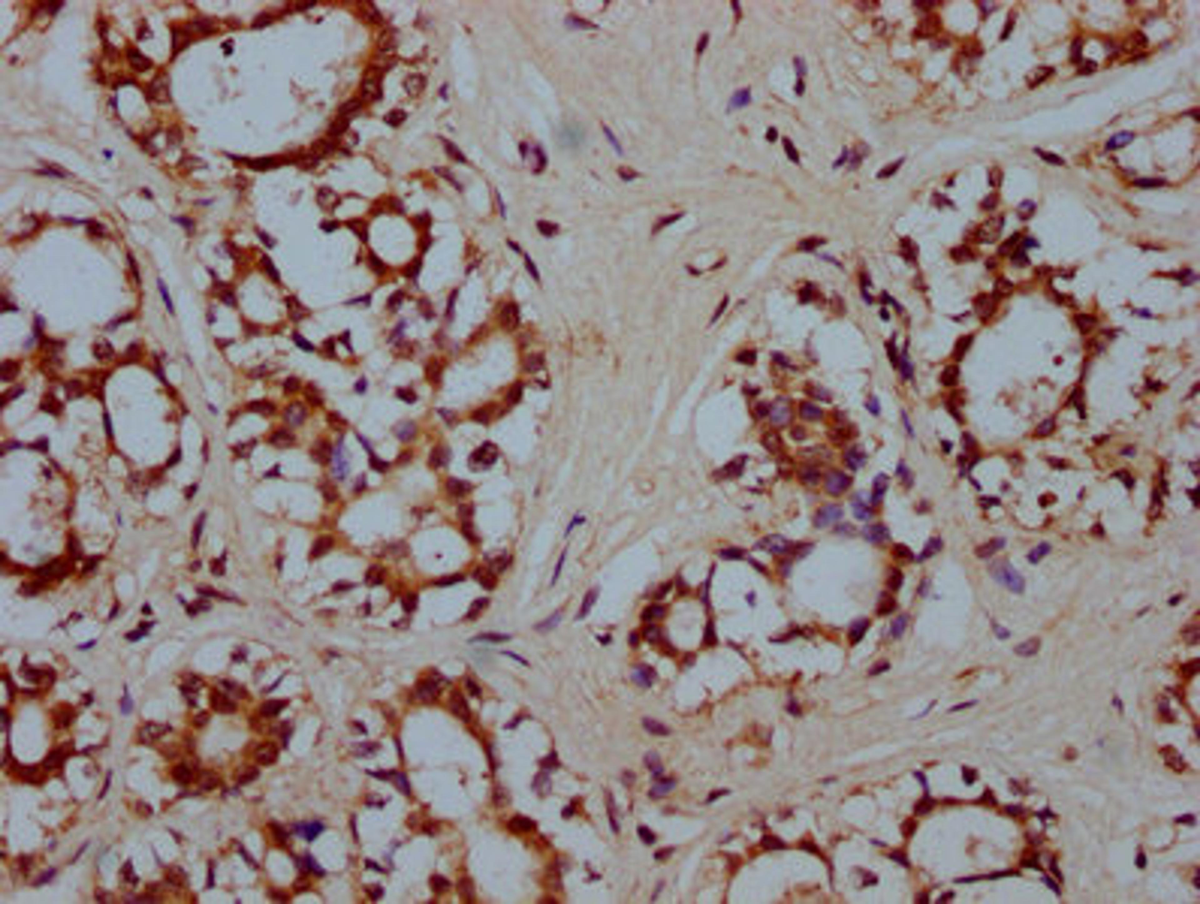 IHC image of CSB-PA010587LA01HU diluted at 1:300 and staining in paraffin-embedded human breast cancer performed on a Leica BondTM system. After dewaxing and hydration, antigen retrieval was mediated by high pressure in a citrate buffer (pH 6.0). Section was blocked with 10% normal goat serum 30min at RT. Then primary antibody (1% BSA) was incubated at 4&deg;C overnight. The primary is detected by a biotinylated secondary antibody and visualized using an HRP conjugated SP system.