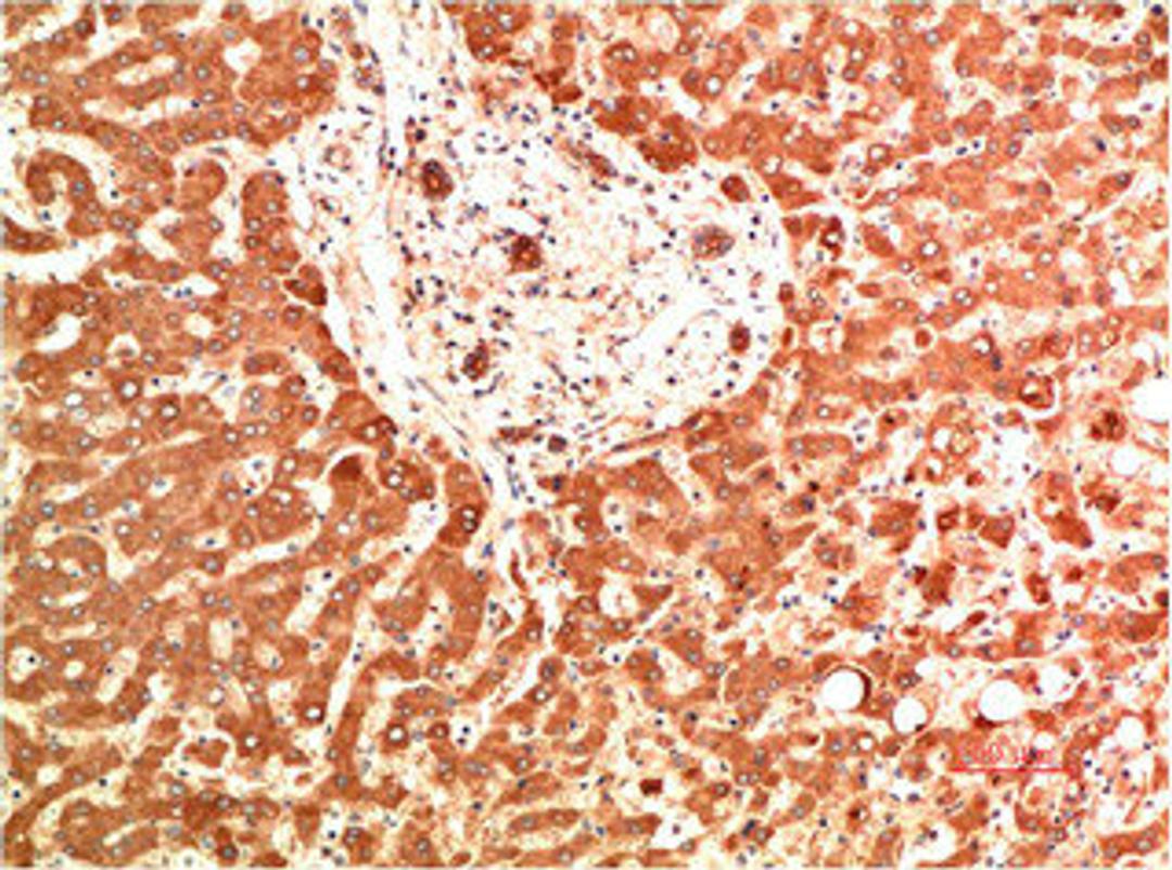 Immunohistochemical analysis of paraffin-embedded Human Liver Carcinoma Tissue using Collagen IV  Mouse mAb diluted at 1:200.