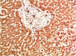 Immunohistochemical analysis of paraffin-embedded Human Liver Carcinoma Tissue using Collagen IV  Mouse mAb diluted at 1:200.