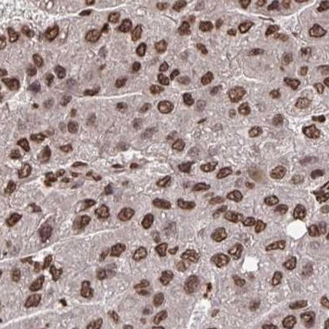 Immunohistochemistry: ZNF593 Antibody [NBP2-31766] - liver cancer