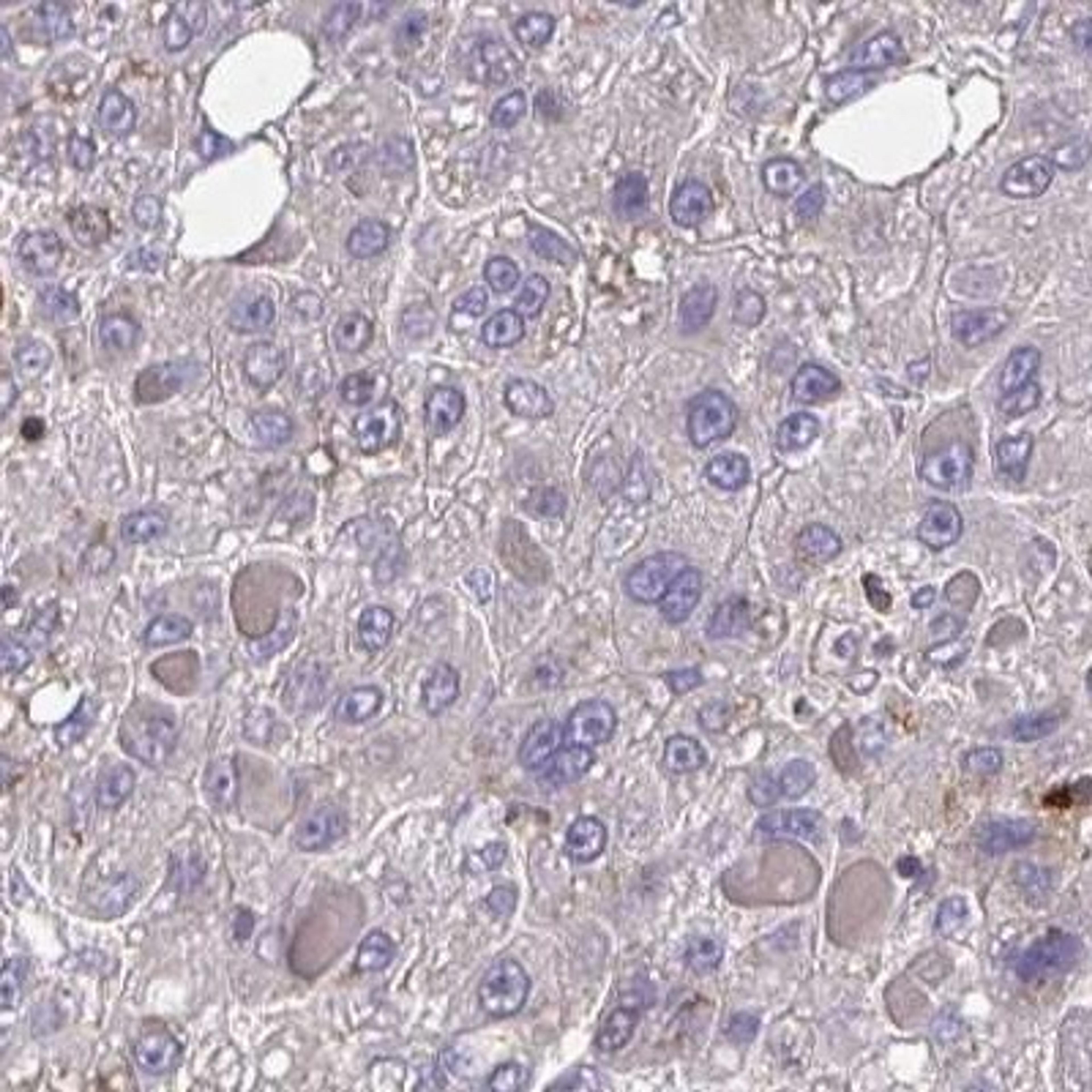 Immunohistochemistry: Prolyl endopeptidase-like Antibody [NBP2-31868] - liver cancer