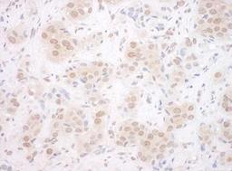 Immunohistochemistry-Paraffin: EYA3 Antibody [NBP1-46818] - Human breast carcinoma. Antibody used at a dilution of 1:200.