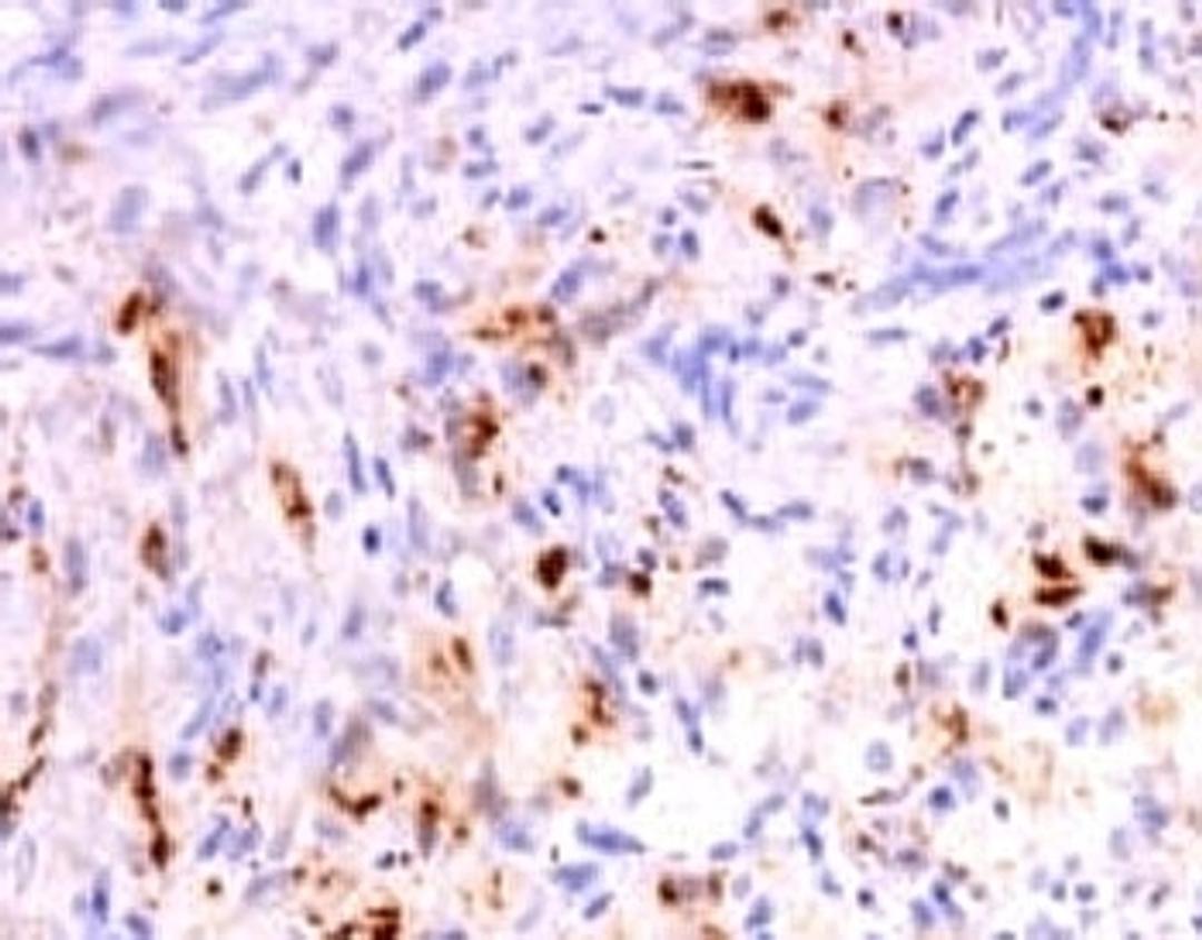 Formalin-fixed, paraffin-embedded human polyostotic sclerosing histiocytosis (Erdheim Chester disease) stained with anti-TNF alpha antibody (SPM543).