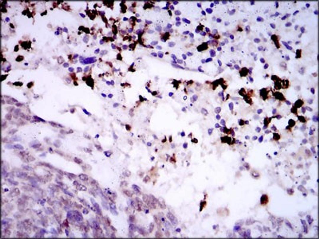 Immunohistochemistry: Spi-B Antibody (4G5) [NBP2-37458] - Immunohistochemical analysis of paraffin-embedded esophageal cancerwith DAB staining.