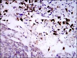 Immunohistochemistry: Spi-B Antibody (4G5) [NBP2-37458] - Immunohistochemical analysis of paraffin-embedded esophageal cancerwith DAB staining.