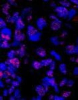 Immunocytochemistry/Immunofluorescence: PLRG1 Antibody [NBP1-06556] - human breast carcinoma.  Antibody dilution of 1:100.