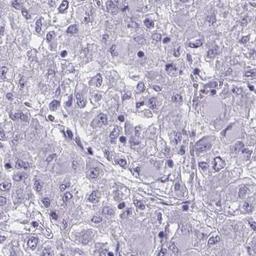 Immunohistochemistry: ZNF182 Antibody [NBP2-32480] - liver cancer