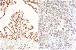 Immunohistochemistry-Paraffin: DHX8 Antibody [NB100-1713] - Human ovarian carcinoma (left) and mouse teratoma (right). Antibody used at a dilution of 1:200 (1ug/ml).