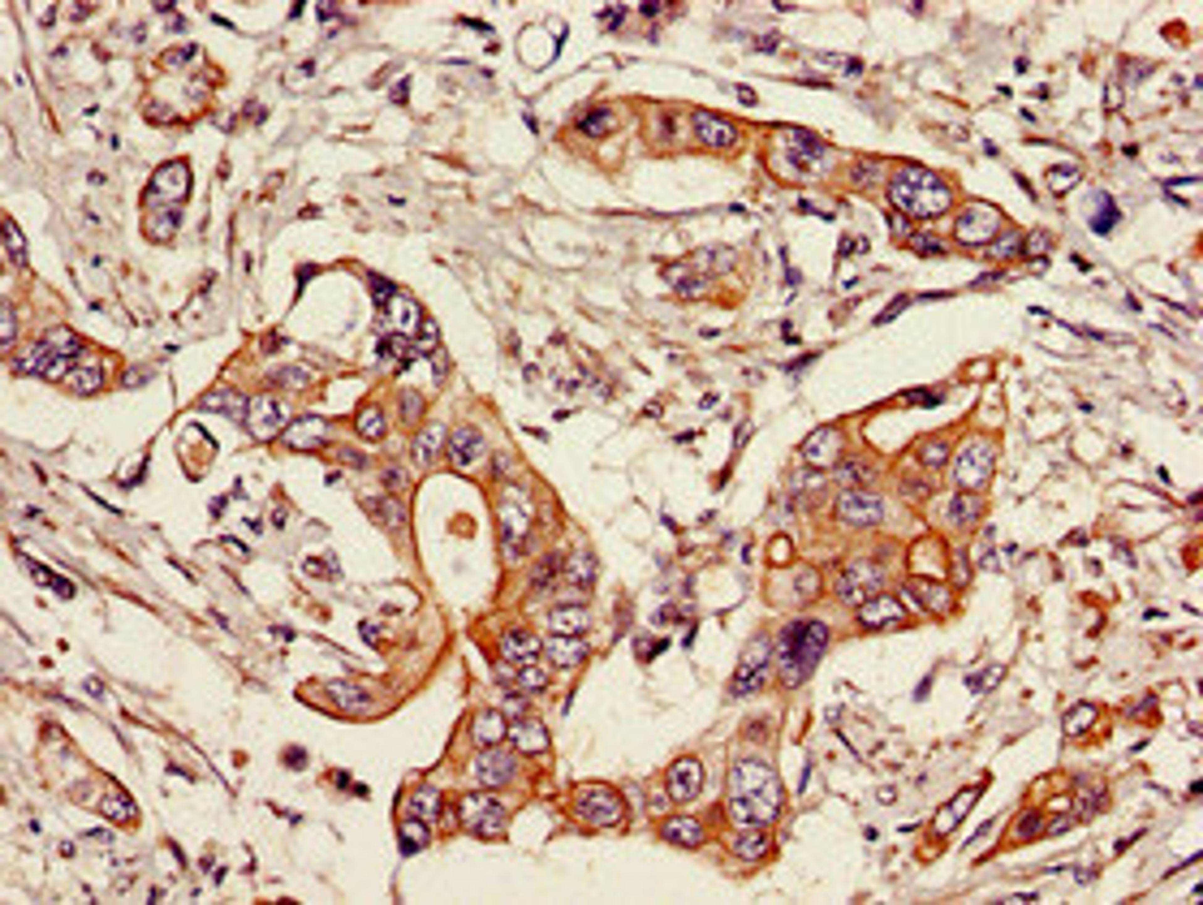Immunohistochemistry of paraffin-embedded human pancreatic cancer using CSB-PA022816LA01HU at dilution of 1:100