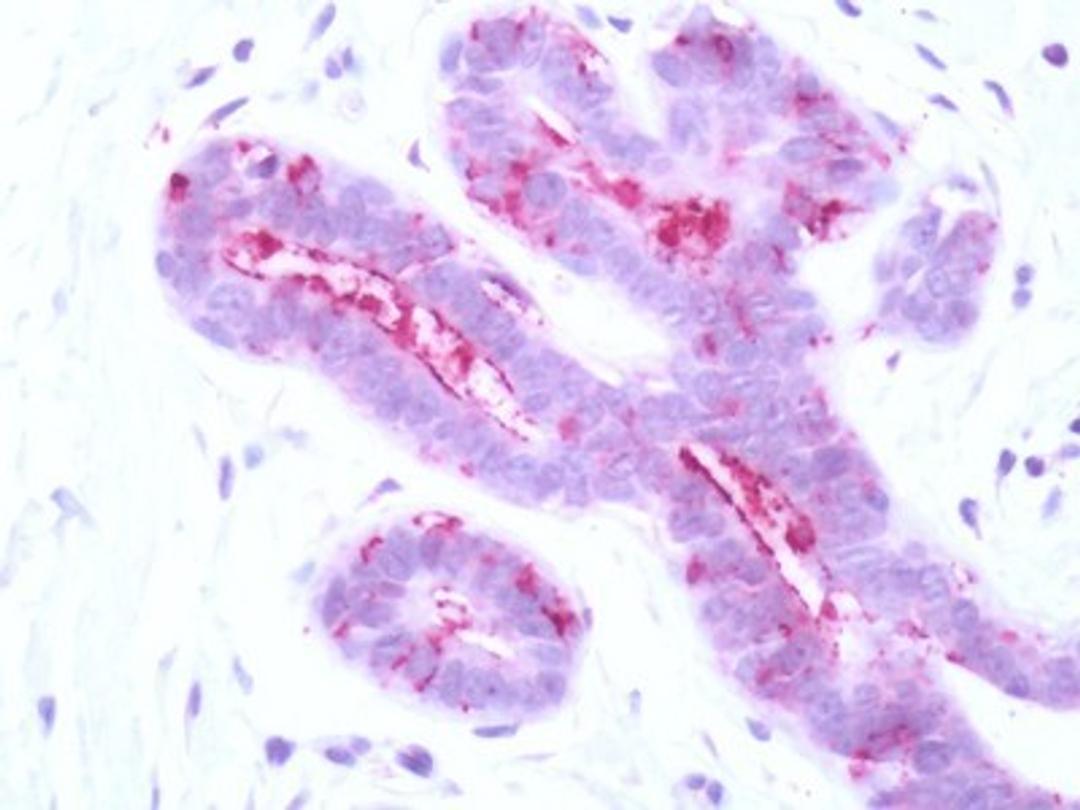 Immunohistochemistry-Paraffin: PAR3/Thrombin Receptor-like 2 Antibody [NLS261] - Analysis of anti-PAR3 antibody with human breast.