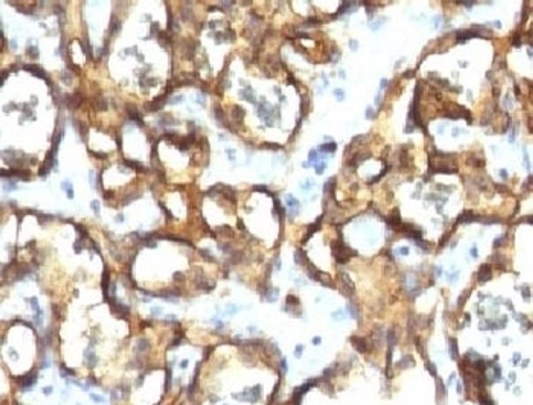 IHC testing of FFPE human angiosarcoma with CD34 antibody (clone CDLA34-1).