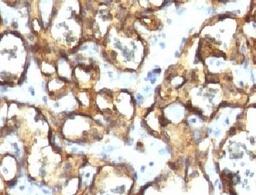 IHC testing of FFPE human angiosarcoma with CD34 antibody (clone CDLA34-1).