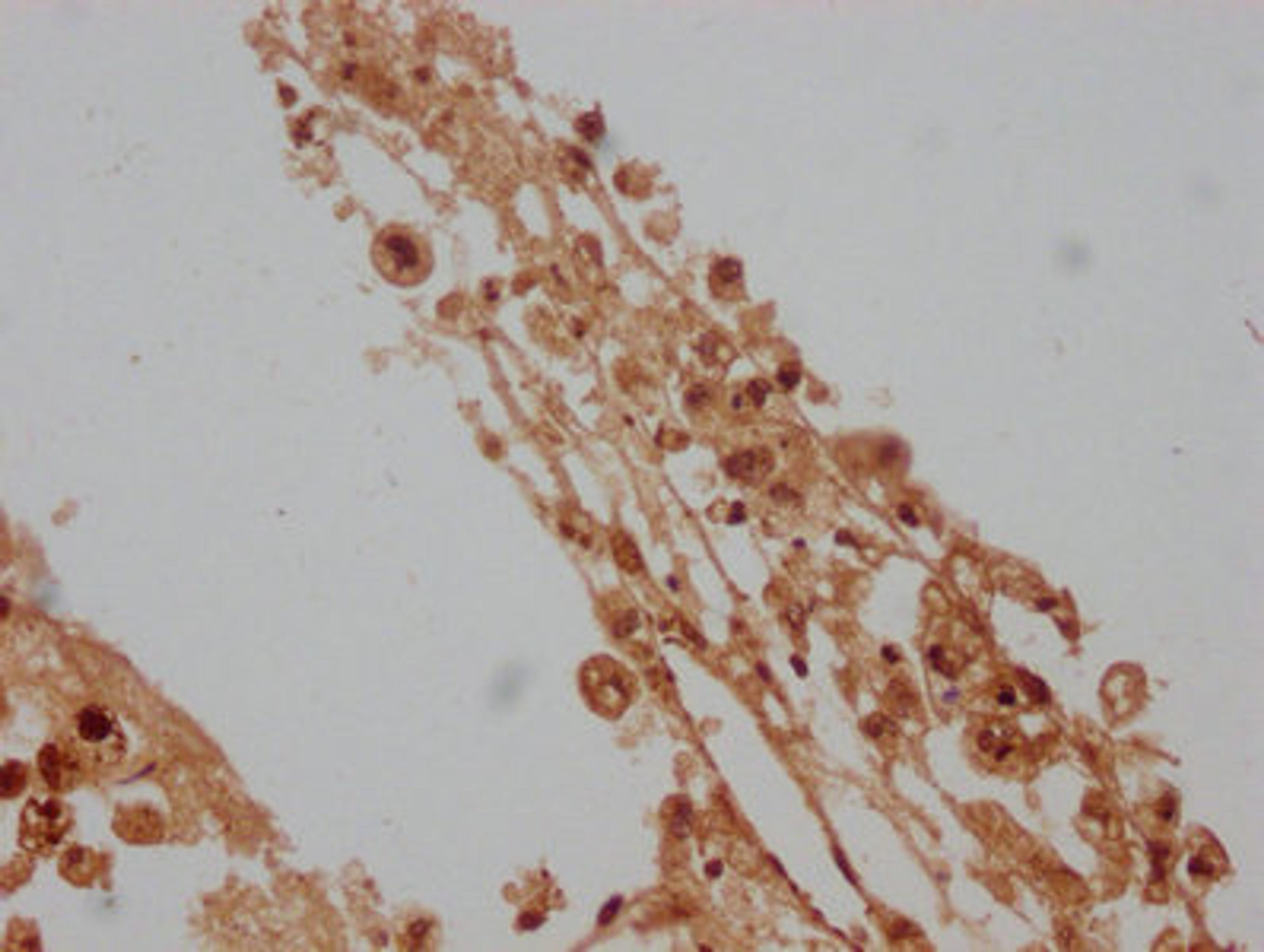 IHC image of CSB-PA012734LA01HU diluted at 1:100 and staining in paraffin-embedded human melanoma cancer performed on a Leica BondTM system. After dewaxing and hydration, antigen retrieval was mediated by high pressure in a citrate buffer (pH 6.0). Section was blocked with 10% normal goat serum 30min at RT. Then primary antibody (1% BSA) was incubated at 4°C overnight. The primary is detected by a biotinylated secondary antibody and visualized using an HRP conjugated SP system.