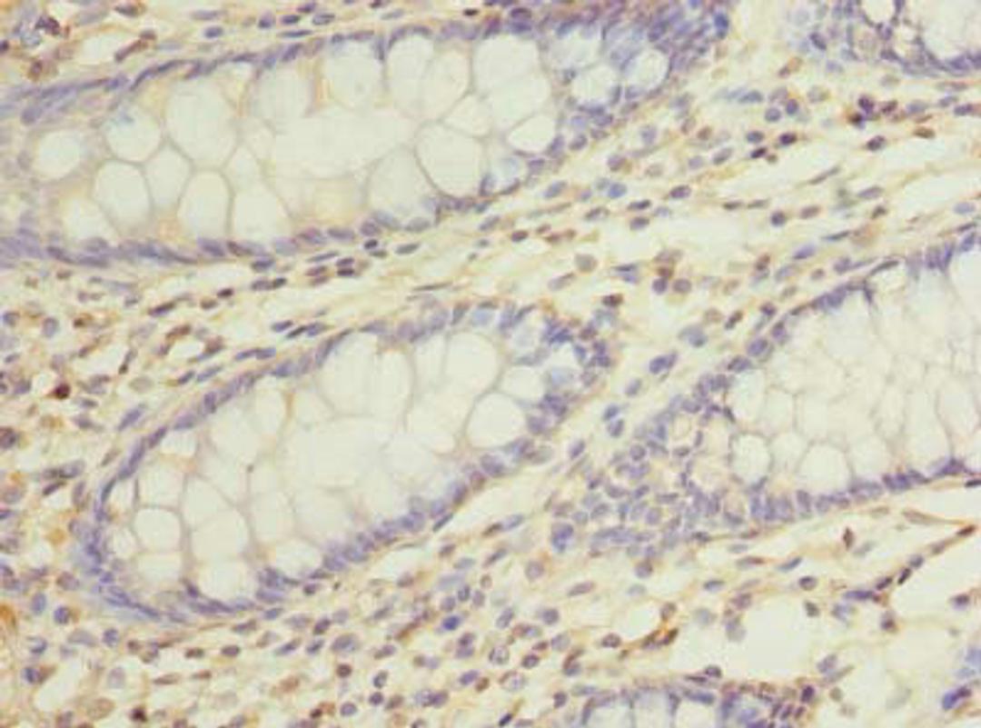 Immunohistochemistry of paraffin-embedded human colon cancer using CSB-PA871585LA01HU at dilution of 1:100