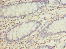 Immunohistochemistry of paraffin-embedded human colon cancer using CSB-PA871585LA01HU at dilution of 1:100