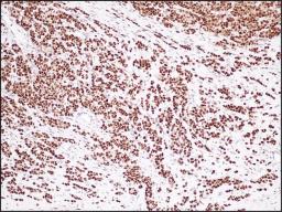 Immunohistochemistry staining of Estrogen Receptor Alpha in human of breast tumor tissue (4 microns) tissue using Estrogen Receptor Alpha Antibody.